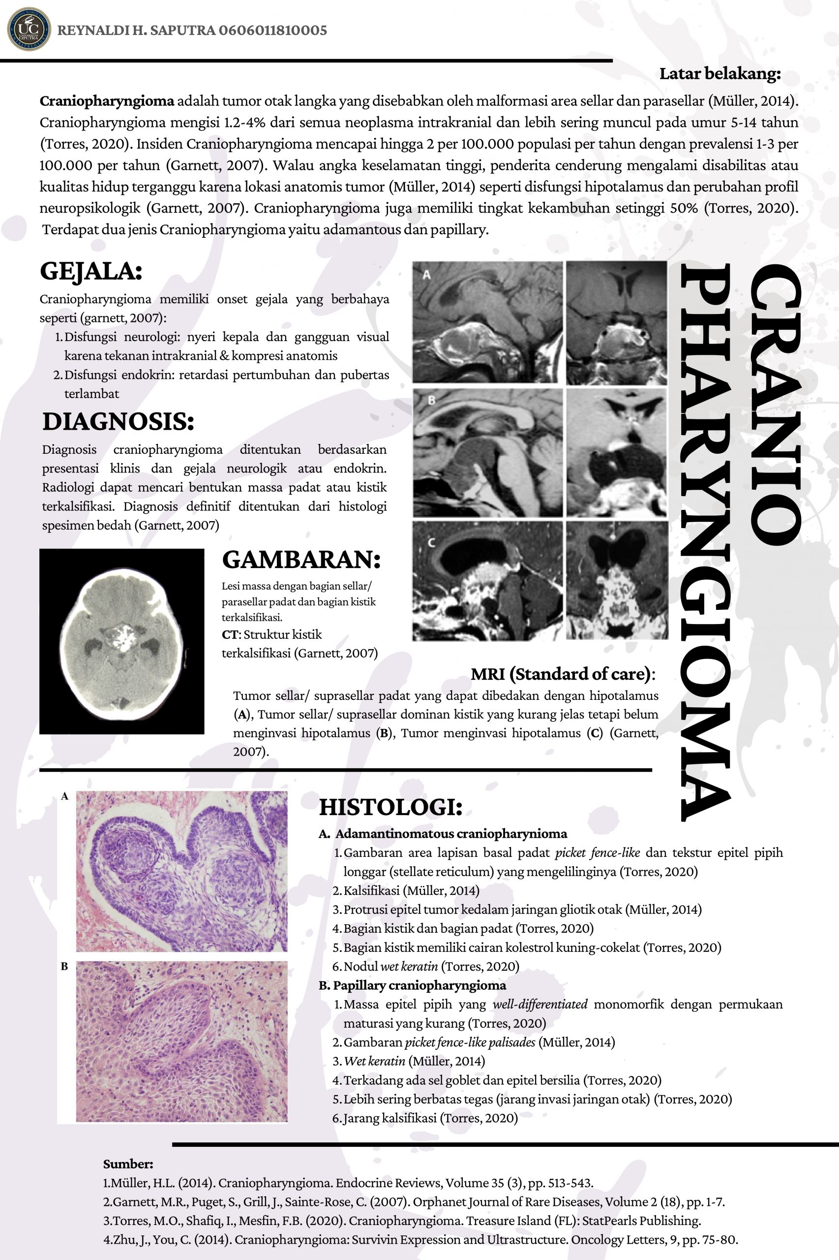 Craniopharyngioma Craniopharyngioma